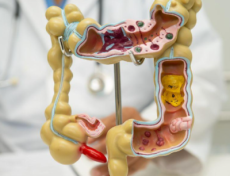 Ministério da Saúde inclui novo teste no SUS para rastrear câncer de intestino