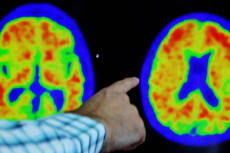 Exames de sangue para detectar Alzheimer custam até R$ 5 mil no Brasil