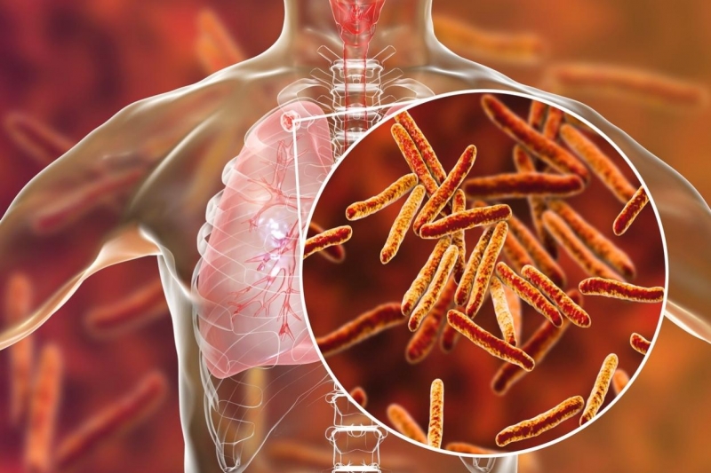 Família de Entre-Ijuís está com suspeita de tuberculose