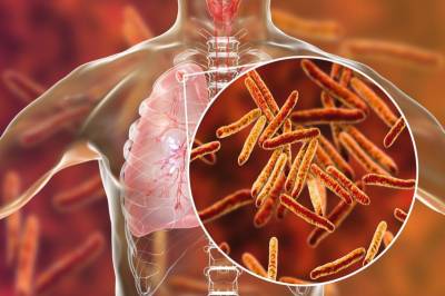 Família de Entre-Ijuís está com suspeita de tuberculose
